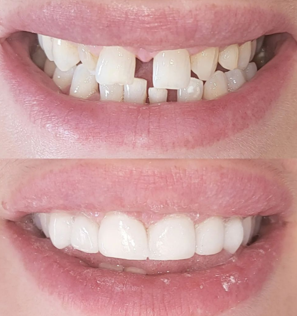 Dental veneers