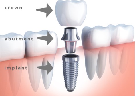 Dental Implants